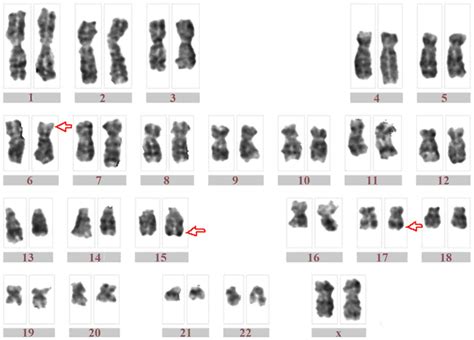 The Novel Threeway Variant T P Q Q In Acute