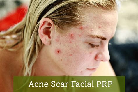 Acne Scar Facial Prp Rainforest Med Spa