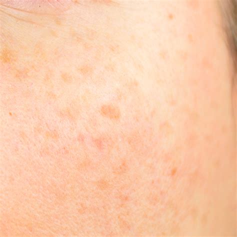 Chronic Skin Conditions White Rock Dermatology