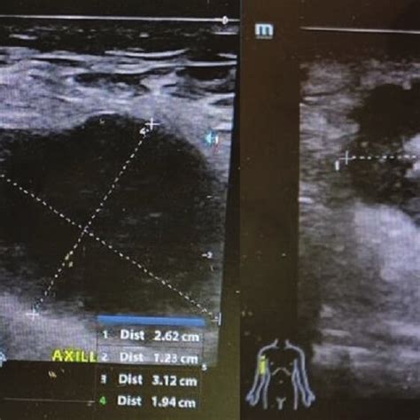 Right axilla diagnostic ultrasound. The image shows axillary ...