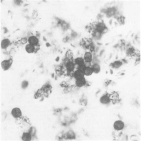 P Carinii Cysts In Mouse Lung Section Methenamine Silver Stain X1250 Download Scientific