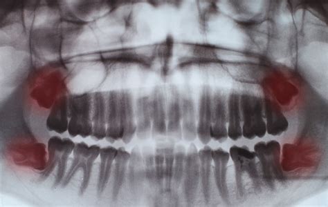 Do Wisdom Teeth Make My Teeth Crooked And The Effects On Orthodontic