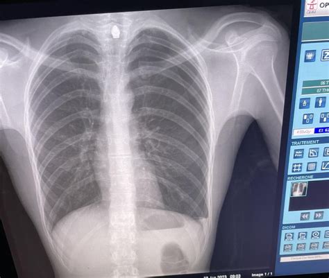 My left clavicle, What do you think? : r/Radiology