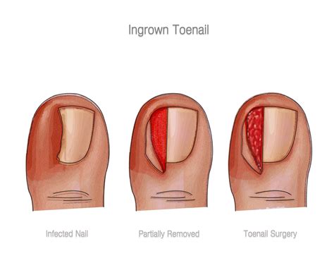 Partial Toenail Avulsion Treatment - Nail Ftempo