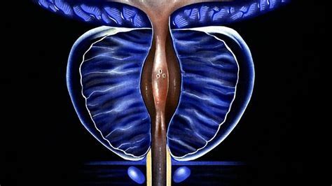 Diagramme De Hypertrophie B Nigne De La Prostate Quizlet