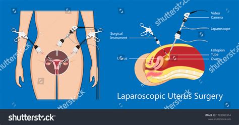 Laparoscopic Hysterectomy Medical Surgical Treat Cervix Stock Vector