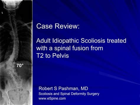 Case Review 11 Adult Idiopathic Scoliosis Ppt