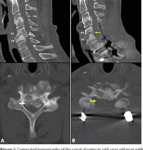 Figure From Uremic Tumoral Calcinosis Of The Cervical Spine