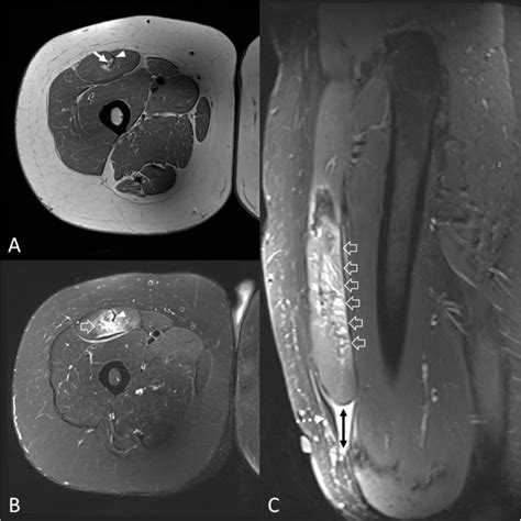 The Impact Of Age And Sex On The Diagnosis Of Intrinsic Rectus Femoris Masses A Single Centre