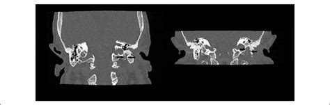 Ct Scan The Evaluation Of Facial Nerve Involvement Is Possible Through