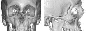 The Custom Eyemask Implant For Aesthetic Periorbital Augmentation