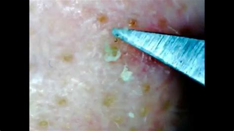 Surgical Blackhead Removal Freeing Up Clogged Pores Youtube