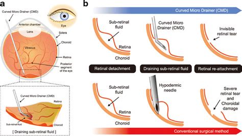 Schematic Representation Of Drainage Of Highly Viscous Subretinal Fluid