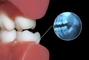 Muelas Del Juicio Saliendo S Ntomas Y Qu Hacer Gaceta Dental