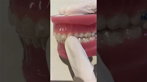 Class Ii Elastics With Invisalign Youtube