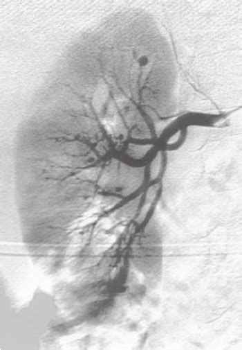 A B Bilateral Selective Renal Arteriograms Show Diffuse Multiple