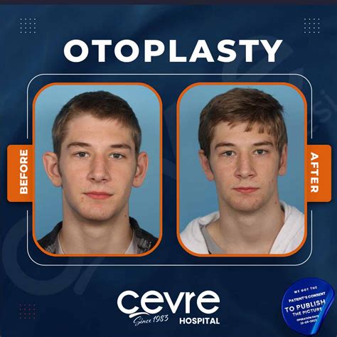 2024 Otoplasty Ear Pinning Surgery In Turkey Cevre Hospital