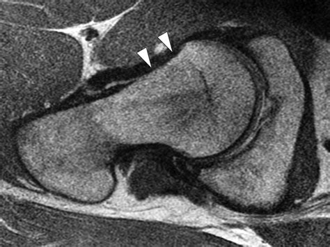 Iliofemoral Ligament Mri