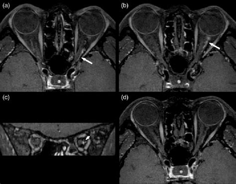 High Resolution Magnetic Resonance Image Findings A B Axial And