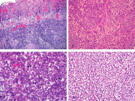 The Tumor Is Composed Of Sheets And Vague Nests Of Epithelioid Or Ovoid