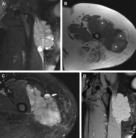 Synovial sarcoma. Synovial sarcoma in a 47-year-old woman with... | Download Scientific Diagram