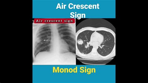 Air Crescent And Monod Sign Cxr Youtube