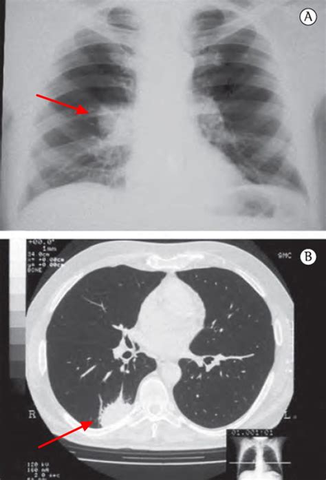 Histoplasmosis - Causes, Symptoms, Diagnosis, Prognosis, Treatment