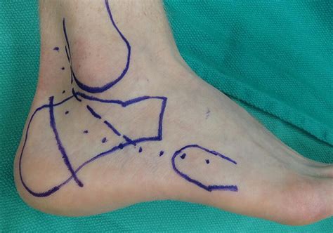 Surgical Technique For Combined Dwyer Calcaneal Osteotomy And Peroneal