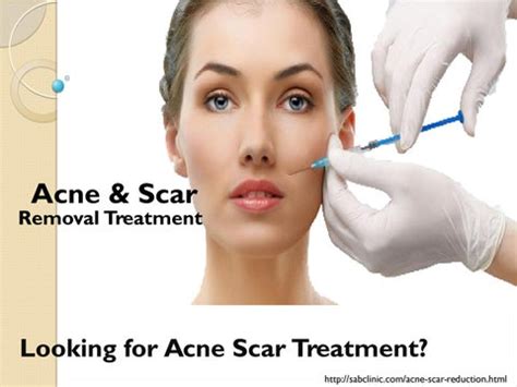 Acne Scar Removal Treatment In Gurgaon By Sabclinic Gurgaon Issuu