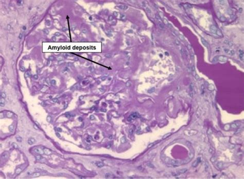 About Amyloidosis Amyloid Center Stanford Medicine