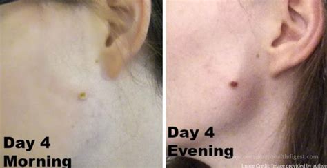 How To Naturally Remove Moles At Home?