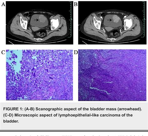 Pdf A Case Of Primary Lymphoepithelioma Like Carcinoma Of The Bladder