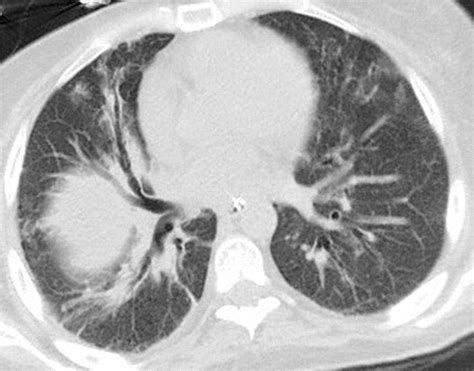 Thoracic Complications Of Precision Cancer Therapies A Practical Guide For Radiologists In The