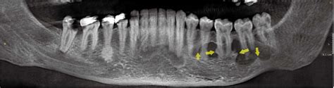 Simple bone cyst in the posterior aspect of the left mandible ...