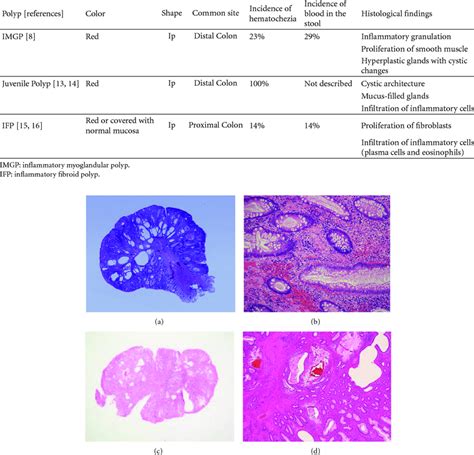 Characteristics Of Inflammatory Myoglandular Polyp Juvenile Polyp And