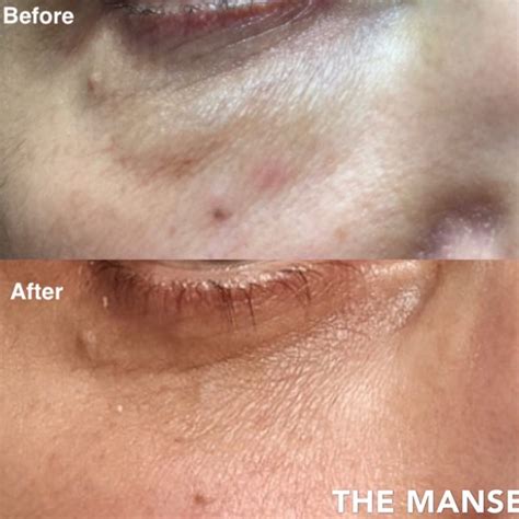 Dissolving Dermal Filler With Hyalase Best Cosmetic Clinic Sydney