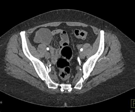 Cirrhosis With Portal Hypertension And Varices And Splenomegaly Liver