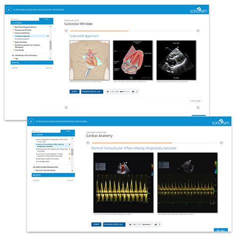 Pericardiocentesis Procedure Ultrasound Guided Technique