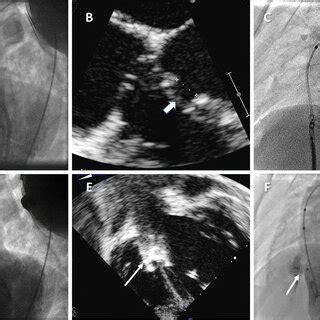 Percutaneous transcatheter muscular VSD closure: The muscular VSD... | Download Scientific Diagram