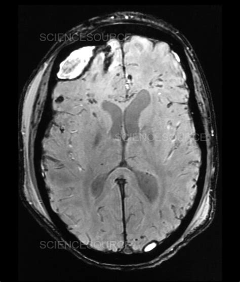 Traumatic Brain Injury MRI | Stock Image - Science Source Images