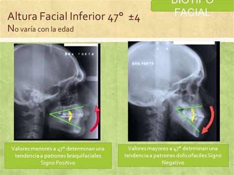 Biotipo Facial El Termino Biotiofacial Es Utilizado En Odontolog A