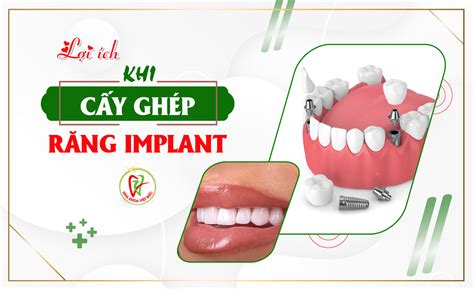 LỢI ÍCH KHI CẤY GHÉP RĂNG IMPLANT Nha Khoa Việt Đức