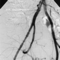 Intra Arterial Digital Subtraction Angiogram Showing The Beaded