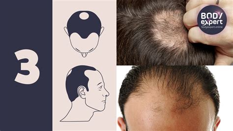 Norwood Hamilton Scale The 7 Stages Of Male Pattern Baldness