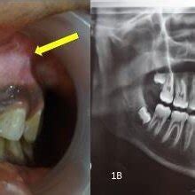 Clinical Findings Of The Patient A Intraoral Photograph Revealing