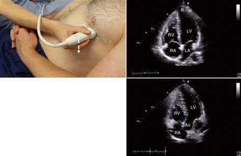 22 Apical Four Chamber View Obtained In A Supine Patient The Probe Is