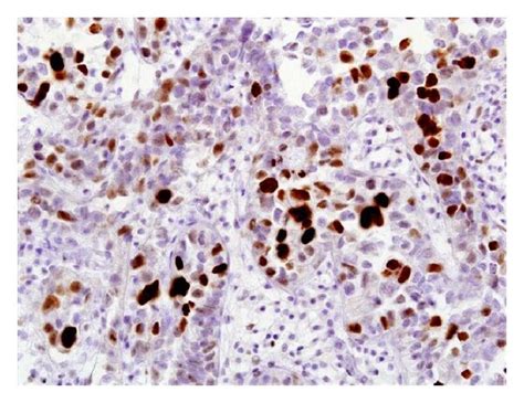 Immunohistochemical Staining Of Clear Cell Adenocarcinoma Showing