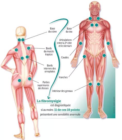 La Fibromyalgie La Vie En Fibromyalgie