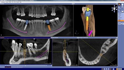 Cone Beam 3 D Imaging Philadelphia PA Laudenbach Periodontics