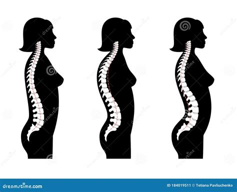 Kyphosis Lordosis Flat Vector Illustration Stock Vector